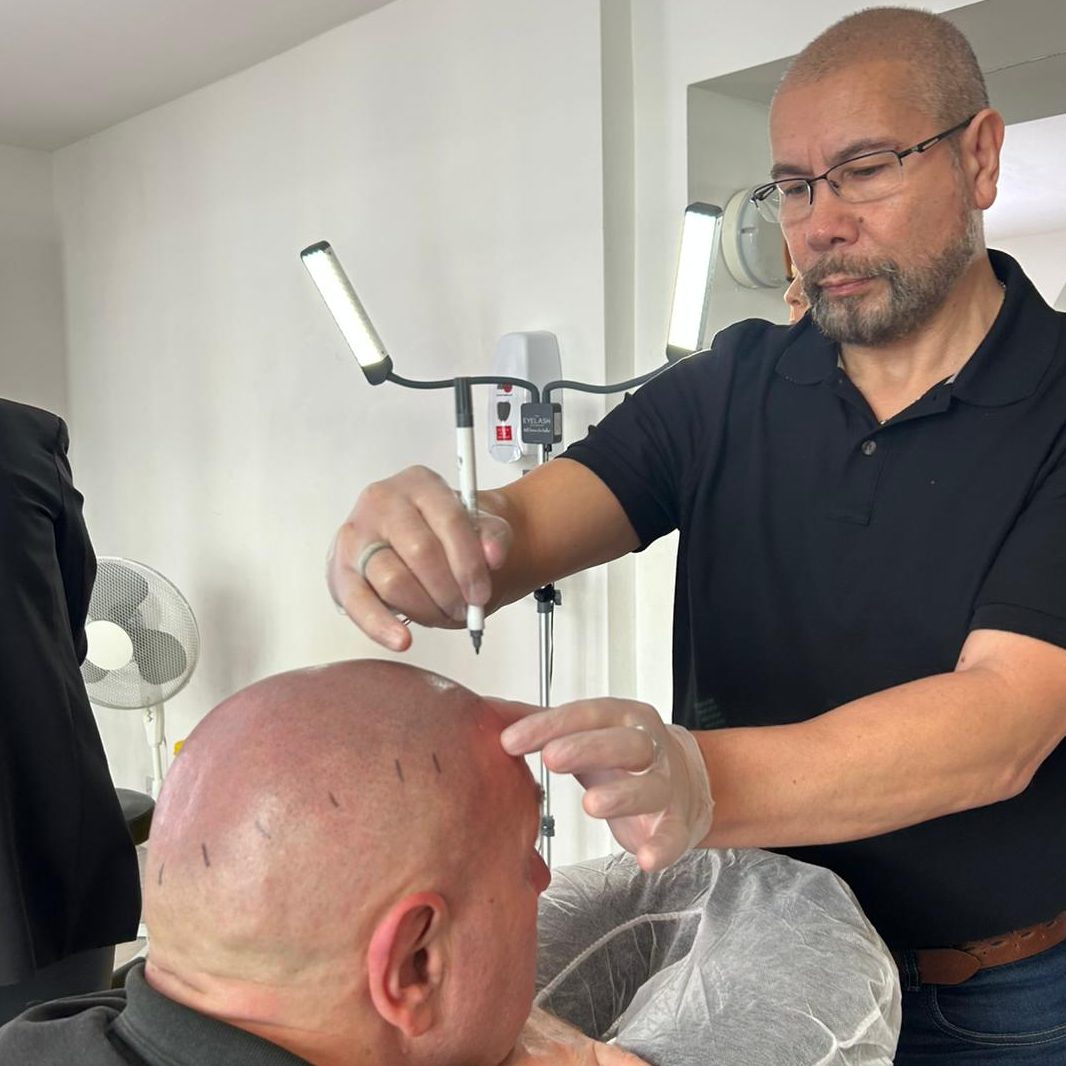 making sure your hairline is natural is the most important aspect of felling you again